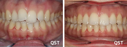 QST Before & After